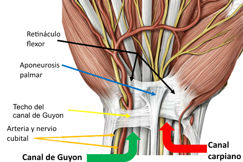 guyon debido al uso incorrecto de bastones y muletas