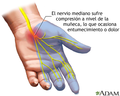 uso de muletas y sindrome tunel carpiano